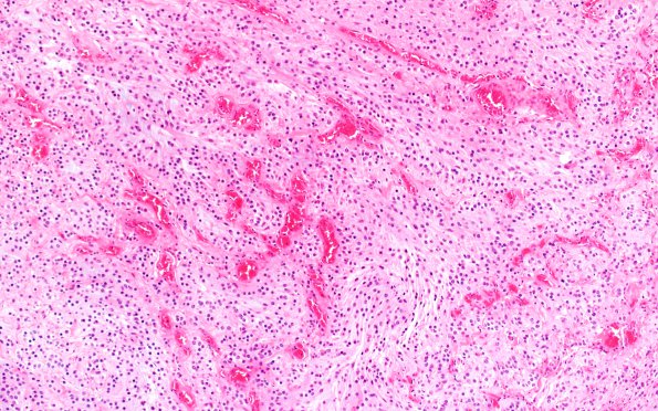 3B4 Astrocytoma, Pilocytic, Optic Nerve (Case 3) A2 GFAP 10X 2