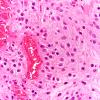 3B5 Astrocytoma, Pilocytic, Optic Nerve (Case 3) A3 H&E 40X 2