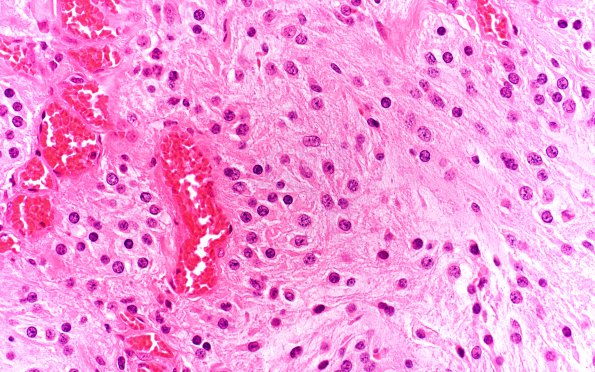 3B5 Astrocytoma, Pilocytic, Optic Nerve (Case 3) A3 H&E 40X 2