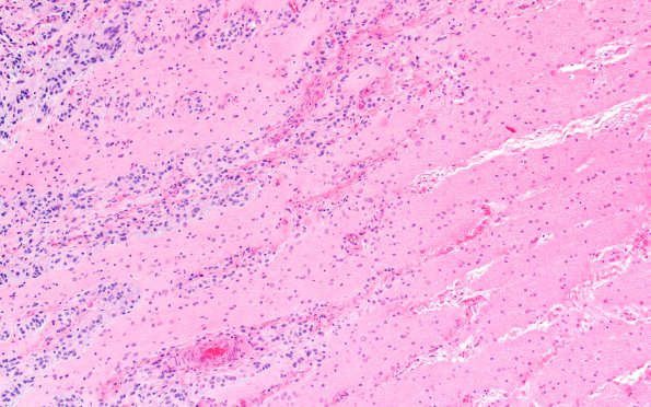 3B6 Astrocytoma, Pilocytic, Optic Nerve (Case 3) A2 GFAP 10X