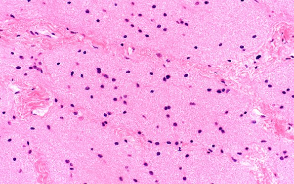 3B7 Astrocytoma, Pilocytic, Optic Nerve (Case 3) A2 nl area H&E 40X