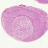 3B8 Astrocytoma, Pilocytic, Optic Nerve (Case 3) H&E WM