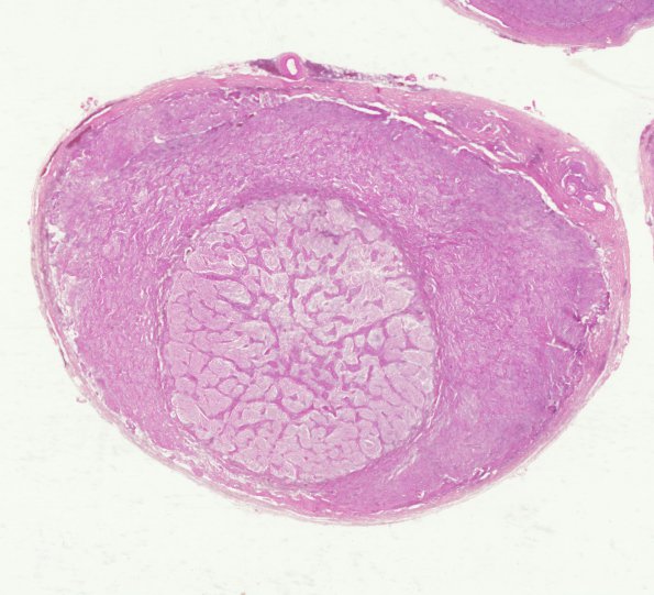 3B8 Astrocytoma, Pilocytic, Optic Nerve (Case 3) H&E WM