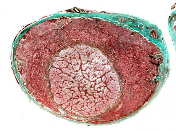 3B9 Astrocytoma, Pilocytic, Optic Nerve (Case 3 TRI WM