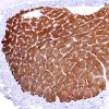 3C1 Astrocytoma, Pilocytic, Optic Nerve (Case 3) A2 nl side H&E 4X