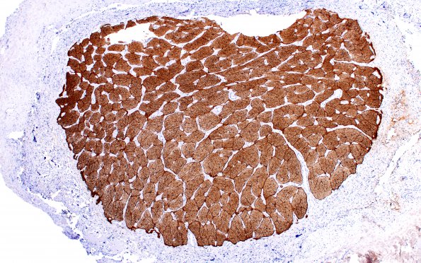 3C1 Astrocytoma, Pilocytic, Optic Nerve (Case 3) A2 nl side H&E 4X