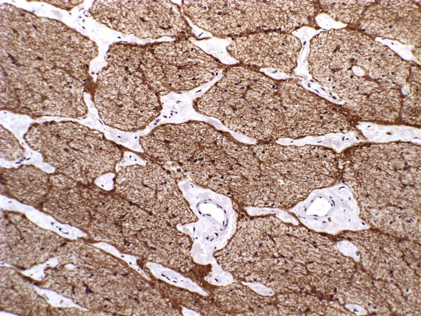 3C2 Astrocytoma, pilocytic, optic nerve (Case 3) GFAP 2