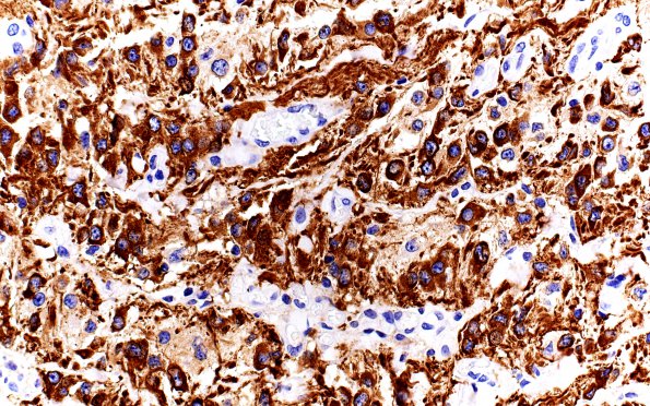 3C3 Astrocytoma, Pilocytic, Optic Nerve (Case 3) A3 GFAP 40X