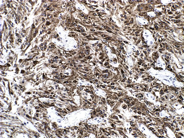 3C4 Astrocytoma, pilocytic, optic nerve (Case 3) GFAP 1