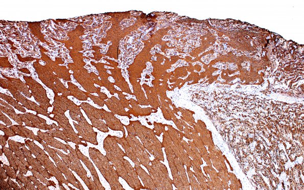 3C5 Astrocytoma, Pilocytic, Optic Nerve (Case 3) A3 GFAP 4X