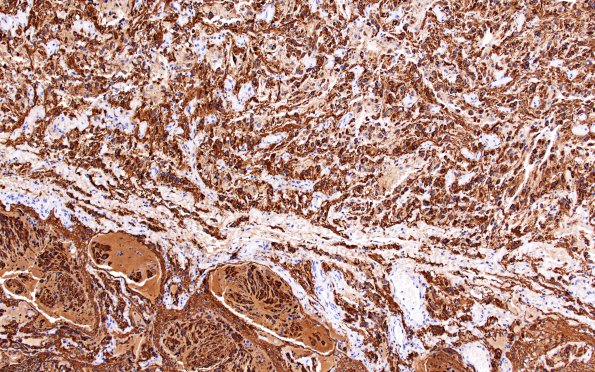 3C6 Astrocytoma, Pilocytic, Optic Nerve (Case 3) A3 GFAP 10X