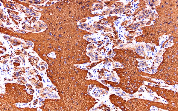 3C7 Astrocytoma, Pilocytic, Optic Nerve (Case 3) A3 GFAP 20X