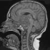 4A0A Astrocytoma, pilocytic (Case 4) T1 - Copy - Copy