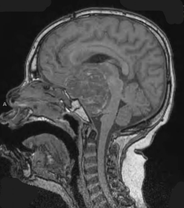 4A0A Astrocytoma, pilocytic (Case 4) T1 - Copy - Copy