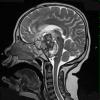 4A0B Astrocytoma, pilocytic (Case 4) T2 W 2 - Copy - Copy