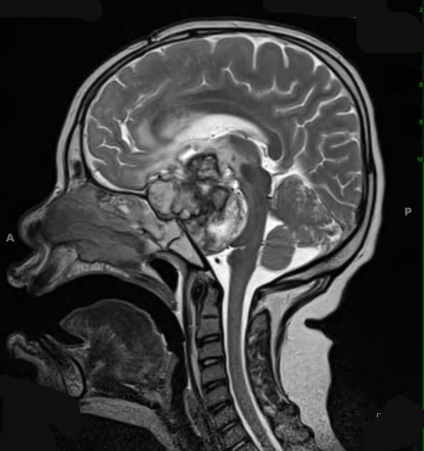 4A0B Astrocytoma, pilocytic (Case 4) T2 W 2 - Copy - Copy