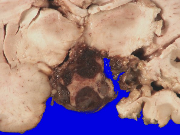 4A1 Astrocytoma, pilocytic (Case 4) gross_2