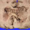 4A2 Astrocytoma, pilocytic (Case 4) gross_1