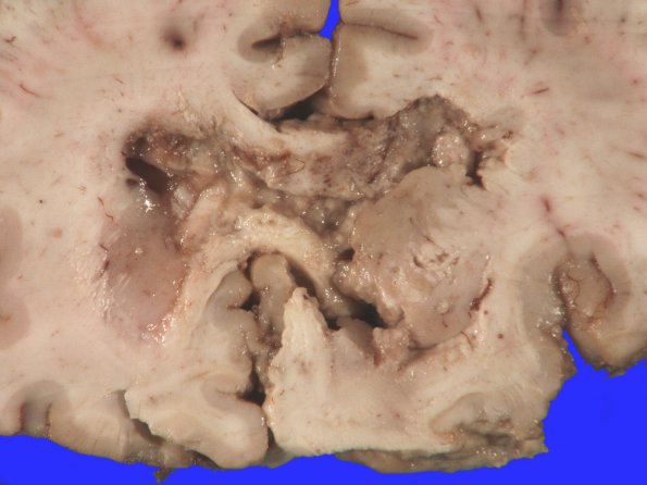 4A2 Astrocytoma, pilocytic (Case 4) gross_1