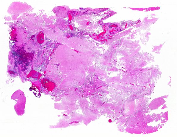 4B1 Astrocytoma, pilocytic (Case 4) N13 H&E WM