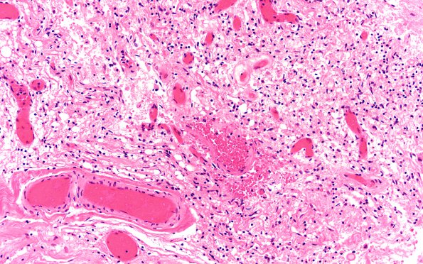 4B2 Astrocytoma, pilocytic (Case 4) N13 H&E 20X 3