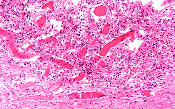 4B3 Astrocytoma, pilocytic (Case 4) N13 H&E 20X