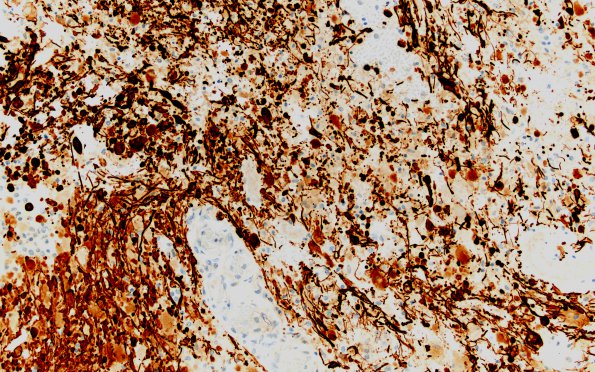 4C2 Astrocytoma, pilocytic (Case 4) GFAP 20X