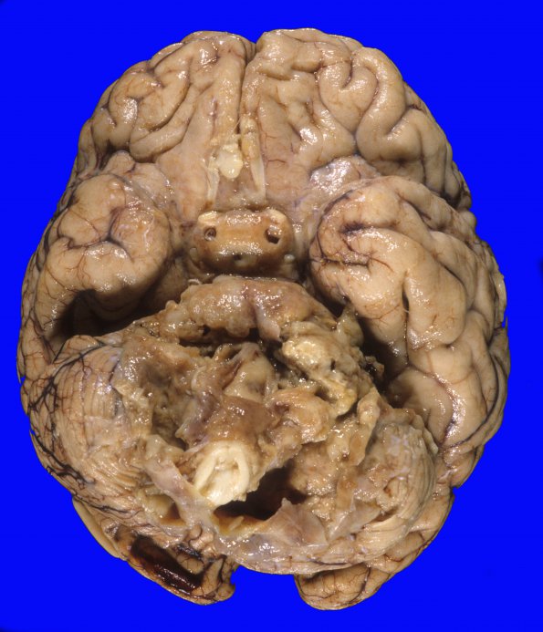 5A1 Astro, pilocytic, Hypothal, dissem (Case 5) 1