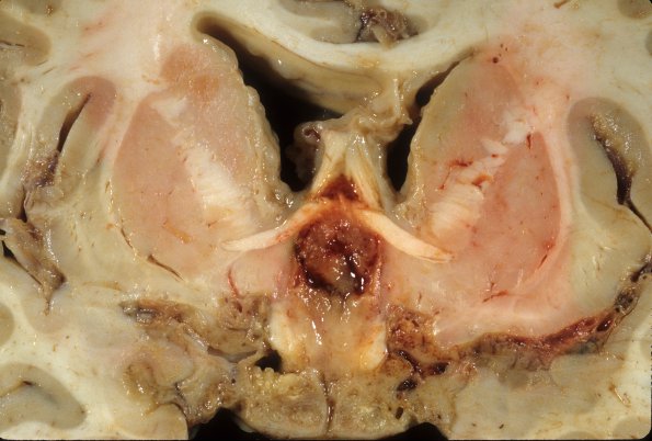 5A3 Astro, pilocytic, Hypothal, dissem (Case 5) 4