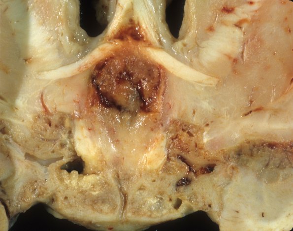 5A4 Astro, pilocytic, Hypothal, dissem (Case 5) 5