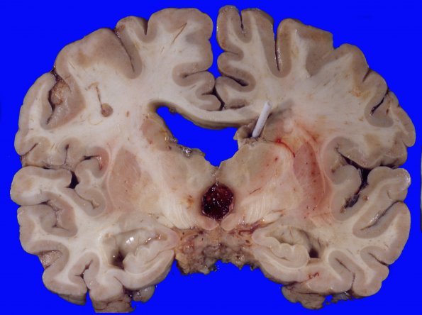 5A5 Astro, pilocytic, Hypothal, dissem (Case 5) A5