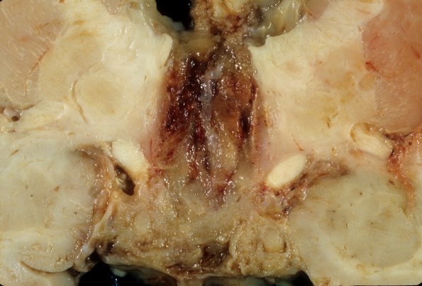 5A6 Astro, pilocytic, Hypothal, dissem (Case 5) 8