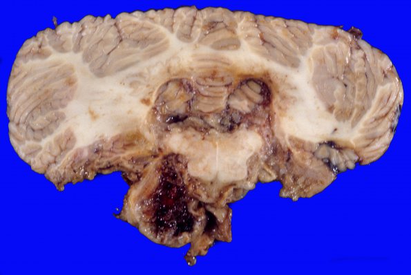 5A8 Astro, pilocytic, Hypothal, dissem (Case 5) A7