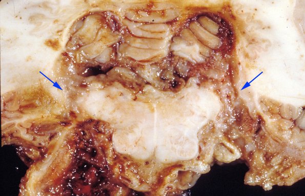 5A9 Astro, pilocytic, Hypothal, dissem (Case 5) 7 copy