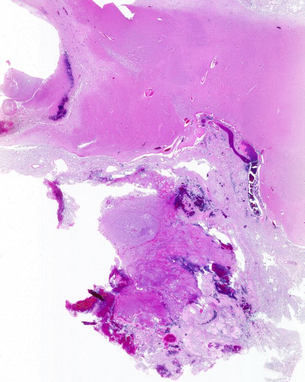 5B1 Astro, pilocytic, Hypothal, dissem (Case 5) N7 WM