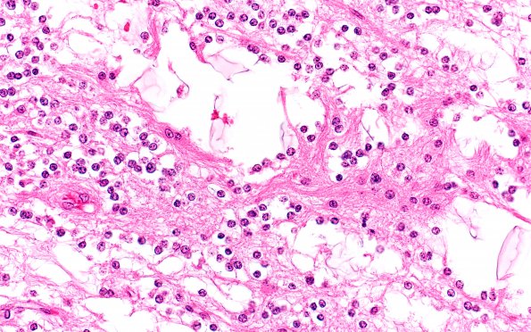 5B3 Astro, pilocytic, Hypothal, dissem (Case 5) B1 40X