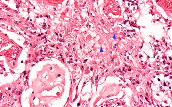 5B4 Astro, pilocytic, Hypothal, dissem (Case 5) N13 H&E 40X copy