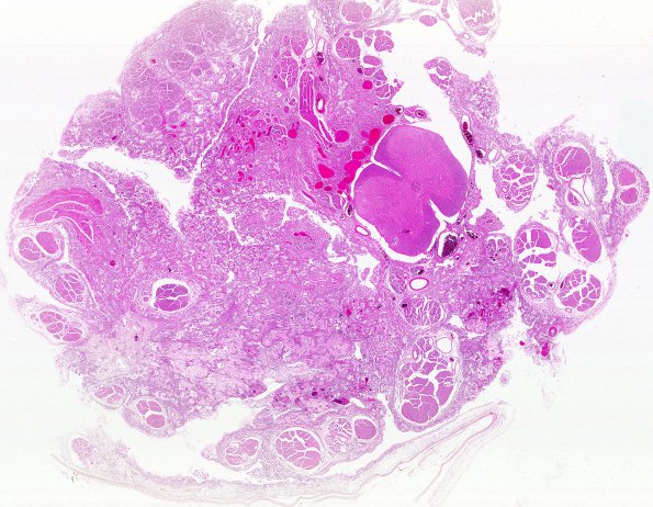 5C1 Astro, pilocytic, Hypothal, dissem (Case 5) N13 H&E WM