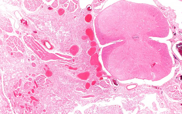 5C2 Astro, pilocytic, Hypothal, dissem (Case 5) N13 H&E 2X