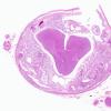 5C3 Astro, pilocytic, Hypothal, dissem (Case 5) H&E WM