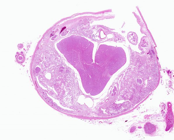 5C3 Astro, pilocytic, Hypothal, dissem (Case 5) H&E WM