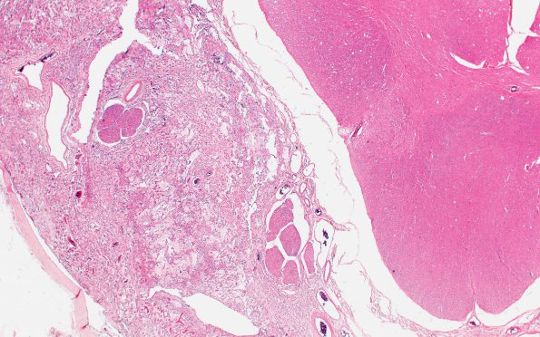 5C4 Astro, pilocytic, Hypothal, dissem (Case 5) N12 2X