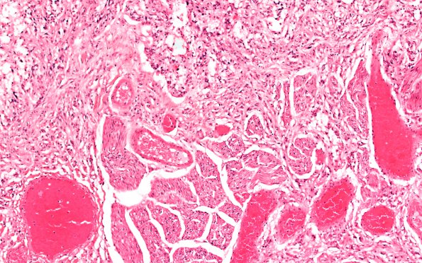 5C6 Astro, pilocytic, Hypothal, dissem (Case 5) N12 10X 3