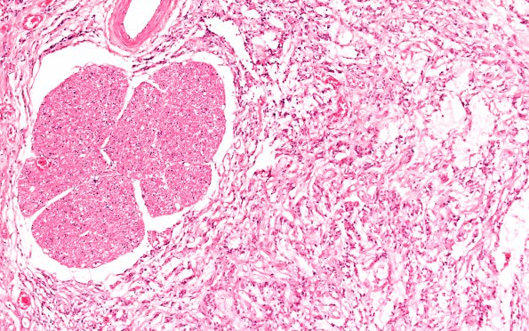 5C7 Astro, pilocytic, Hypothal, dissem (Case 5) N12 10X