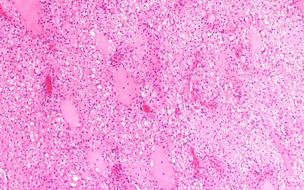 6B3 (Case 6)  H&E scan 10X