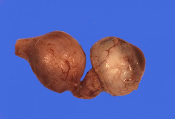 7A1 Astrocytoma, pilocytic, optic nerve (Case 7) 1