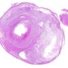 7B1 Astrocytoma, pilocytic, optic nerve (Case 7) H&E WM