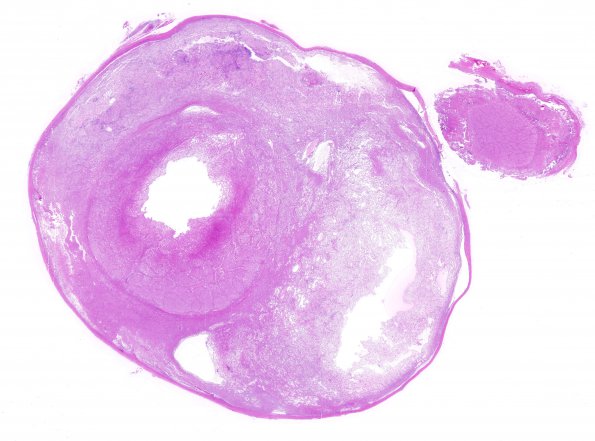 7B1 Astrocytoma, pilocytic, optic nerve (Case 7) H&E WM