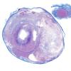 7B2 Astrocytoma, pilocytic, optic nerve (Case 7) Trichrome WM