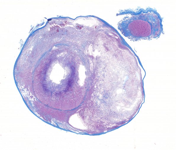 7B2 Astrocytoma, pilocytic, optic nerve (Case 7) Trichrome WM